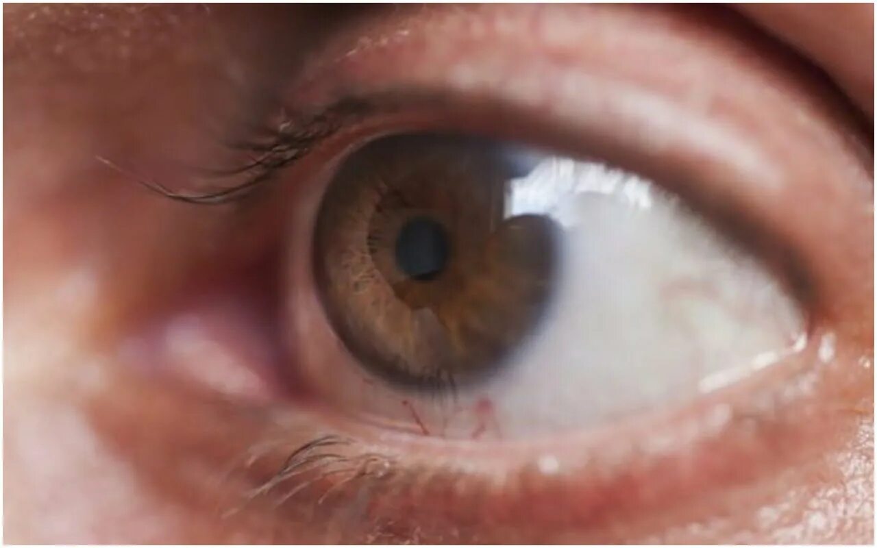 Глазная болезнь глаукома. Глаукома начальная стадия. Глазная глаукома симптомы. Глаукома внутриглазное.