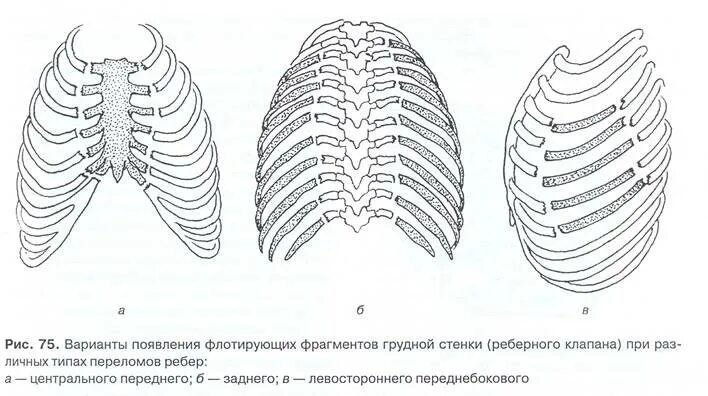 Множественные ребра