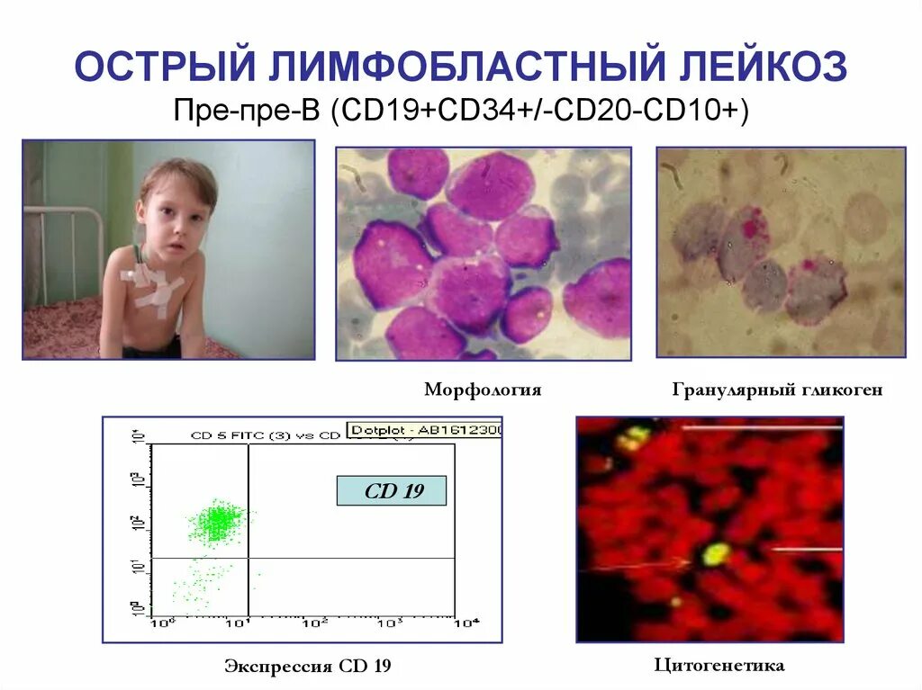 Острый лимфобластный лейкоз у детей. Остром лимфобластном лейкозе симптомы. Острый лимфобластный лейкоз в2. Острый макро лимфобластный лейкоз. Лимфобластный лейкоз у взрослых