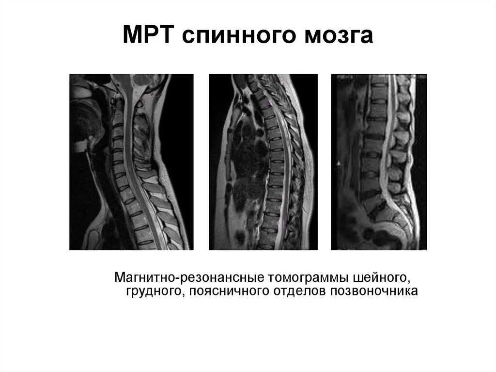 Мрт спинного мозга и позвоночника