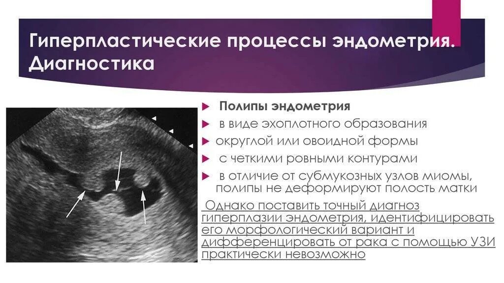 Полип после медикаментозного прерывания. Атипическая гиперплазия эндометрия УЗИ. Атипическая гиперплазия эндометрия диагноз. Гиперпластические процессы эндометрия УЗИ.