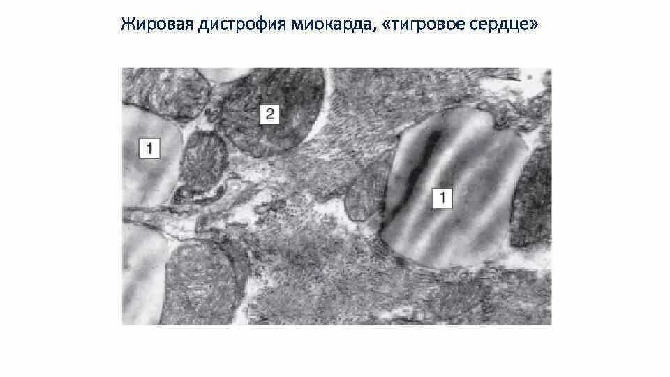 Дистрофия латынь. Электронограмма миокарда. Жировая дистрофия кардиомиоцитов Электронограмма. Кардиомиоцит Электронограмма. Апоптоз Электронограмма.