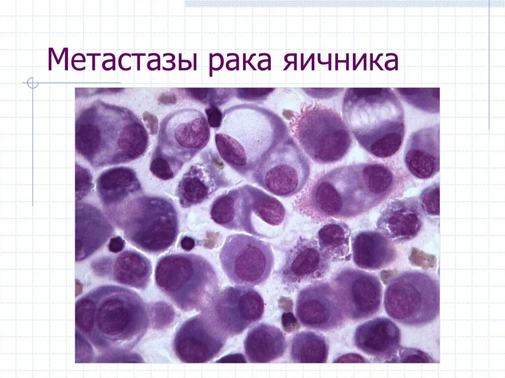 Асцит на узи брюшной полости. Жидкость в метастазах. Свободная жидкость в брюшной полости на узи. Цитологическая диагностика выпотных жидкостей. Жидкость в метастазах.