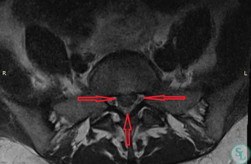 Протрузия дисков l2 l3 l4 l5. Диск l5-s1. Грыжа диска l5-s1. Экстрафораминальная грыжа диска l5-s1. Левосторонняя грыжа диска l5-s1.