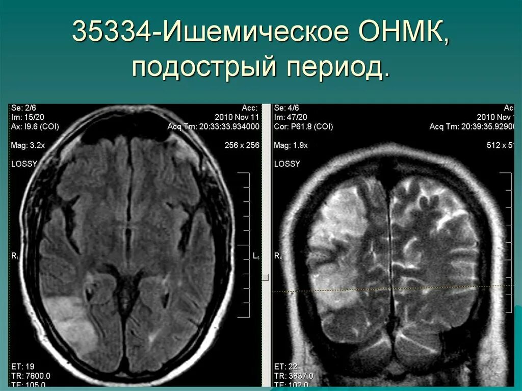 Острое нарушение мозгового кровообращения по ишемическому типу. Кистозно-глиозные изменения головного мозга кт. онмк по ишемическому типу кт. онмк по ишемическому типу мрт. подострый ишемический инсульт на кт.