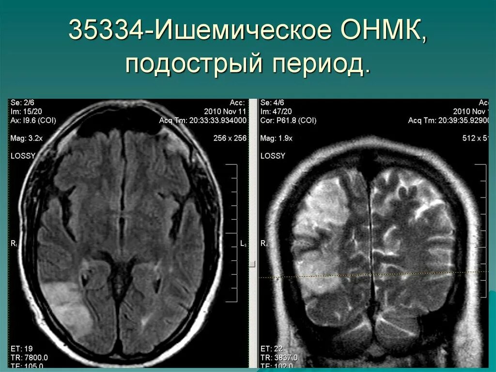 Ишемический инсульт на кт головного мозга. Ишемический инсульт кт и мрт. ОНМК по ишемическому типу кт. Мрт головного мозга инсульт.