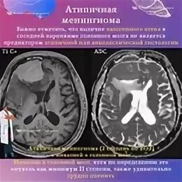 После операции менингиомы головного мозга. Локализация менингиом головного мозга. Кальцинированная менингиома.