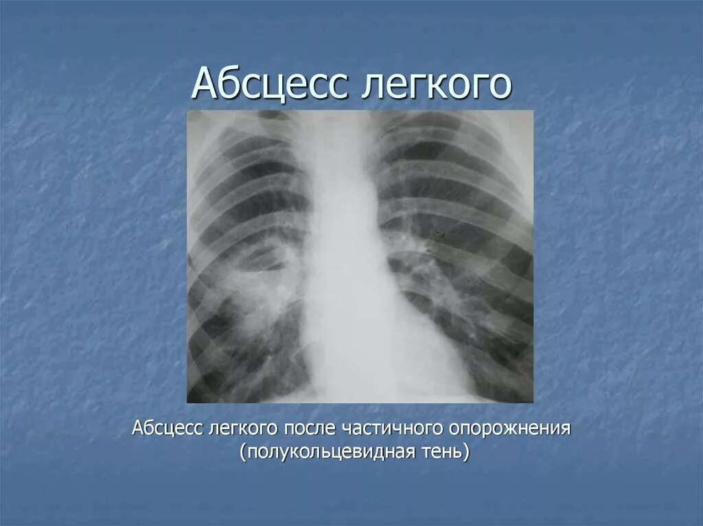 После абсцесса легкого. Частично Опорожненный абсцесс легкого. Абсцесс легкого лучевые исследования. Абсцесс легкого в стадии опорожнения.