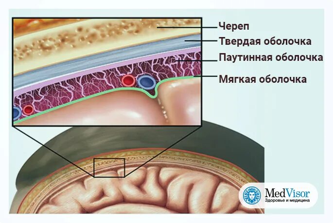 Воспаление мозга на латинском. Оболочка головного мозга менингит. Менингит оболочки головного и спинного мозга. Менингит воспаление паутинной оболочки. Воспаление оболочек головного мозга.