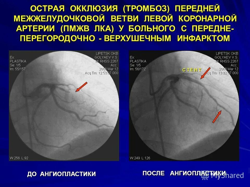 перфорация коронарной артерии. пмжв каранароангиография. коронарография окклюзия. пмжв. коронарография стеноз.