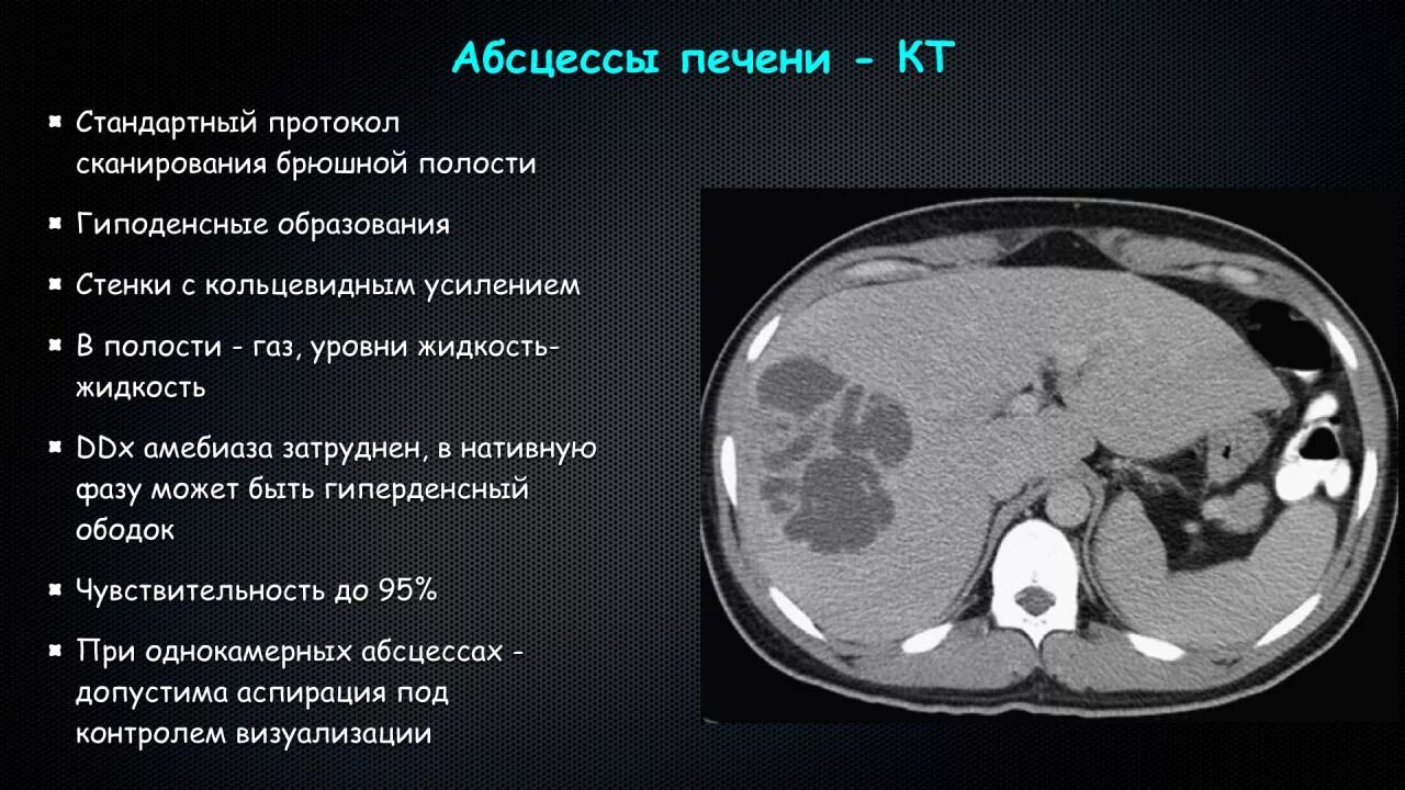 Абсцесс печени кт картина. Эхинококковая киста печени кт. Образования печени кт