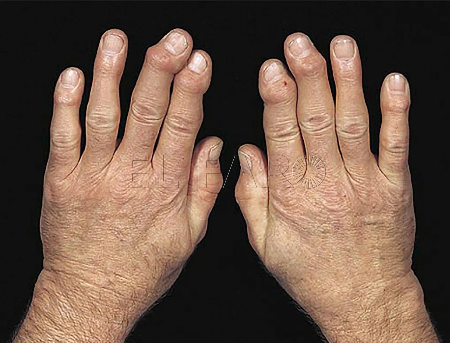 Больные пальцы рук. Узелки Гебердена ревматоидный артрит. Узелки Гебердена и Бушара ревматоидный артрит. Остеоартроз узелки Гебердена. Гебердена узелки Гебердена.