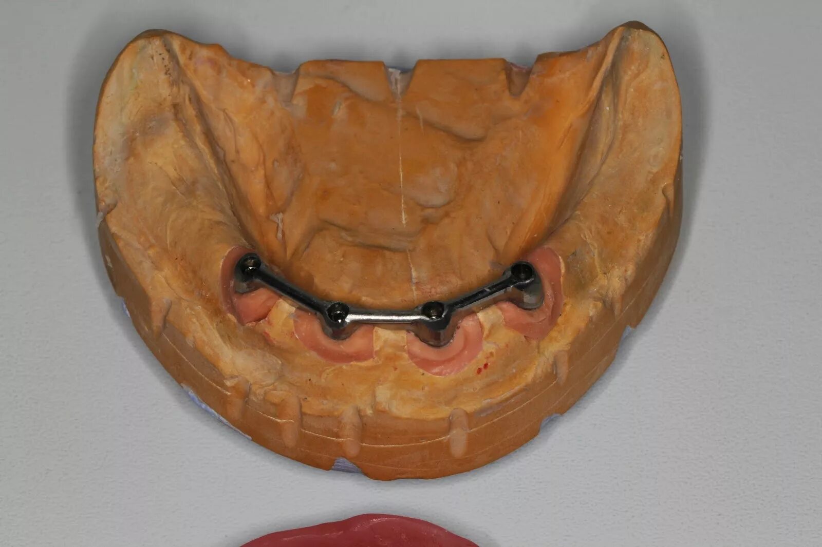 балочная система фиксации бюгельных протезов. съемный протез с балочной системой фиксации. бюгельный протез балочная система. балочная фиксация съемных протезов. бюгельный протез замковый (2 замка bredent).