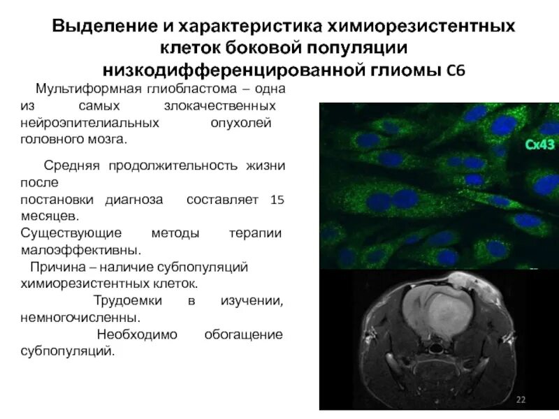 Мультиформная глиобластома. Глиома опухоль головного мозга симптомы. Мультифокальный рост опухоли головного мозга. Глиобластомы головного мозга.