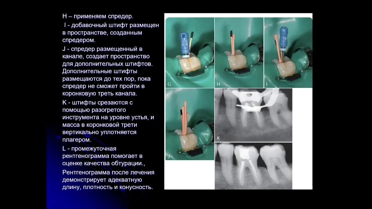 Методы пломбирования корневых. Метод латеральной конденсации для пломбирования корневых каналов. Гибридная техника пломбирования корневых каналов. Гибридная методика обтурации корневых каналов. Гибридная методика пломбирования корневых каналов.