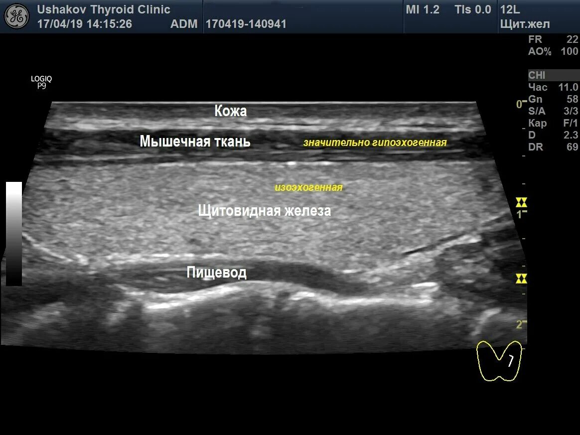 Изоэхогенный узел щитовидной железы на УЗИ. Изоэхогенный узел щитовидной железы что это такое. Нижний полюс щитовидной железы на УЗИ. Гипоэхогенный узел щитовидной. Щитовидная железа узи лимфоузлы