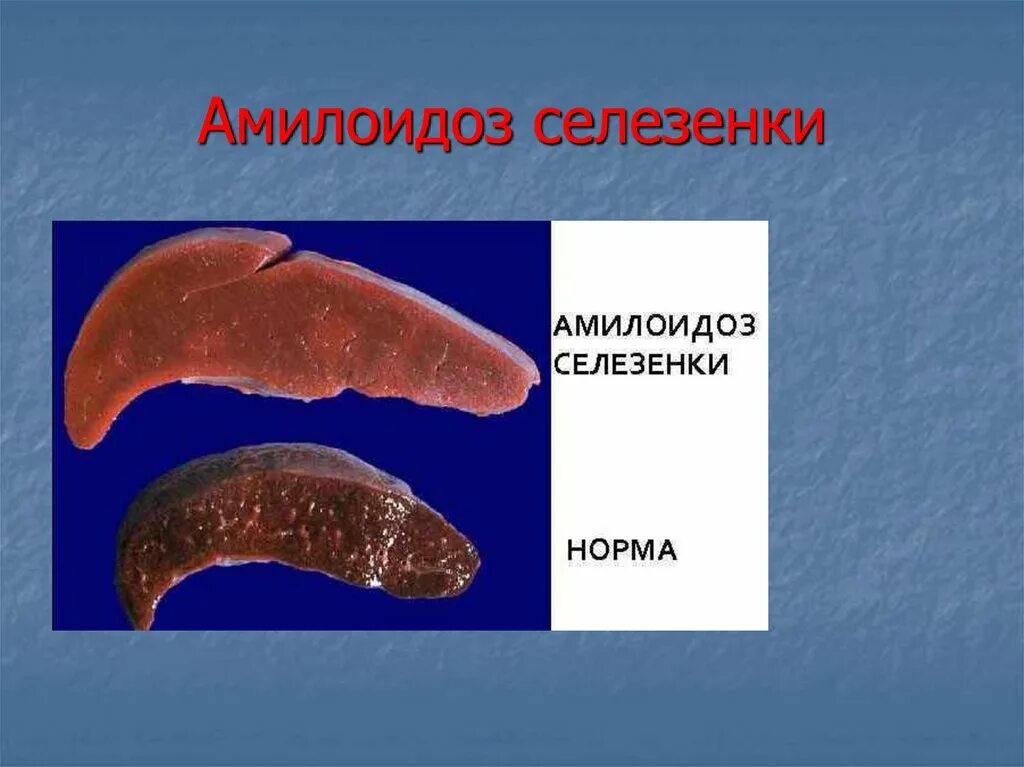 Саговый амилоидоз селезенки. Саговый амилоидоз селезенки