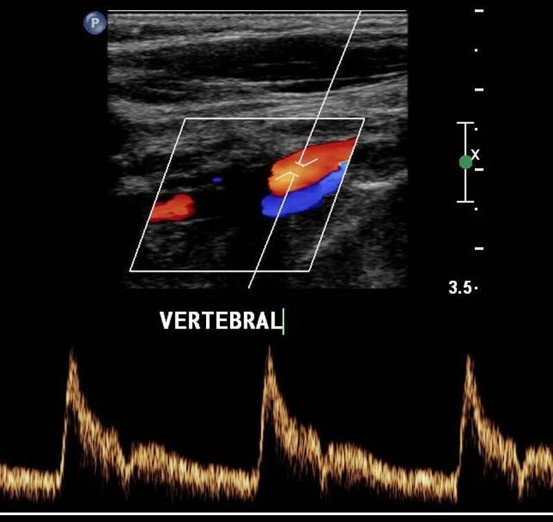 Доплер кровотоки. Спектр кровотока в позвоночной артерии. Допплерография, спектр кровотока. Стеноз позвоночных артерий на УЗИ. УЗИ сосудов позвоночных артерий.