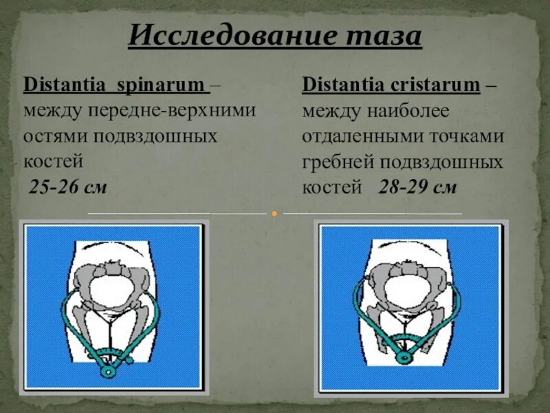 Костный таз акушерство. Измерение поперечного размера выхода таза. Дистанция спинарум равна. Измерение таза в акушерстве у беременных. Дистанция спинарум равна.