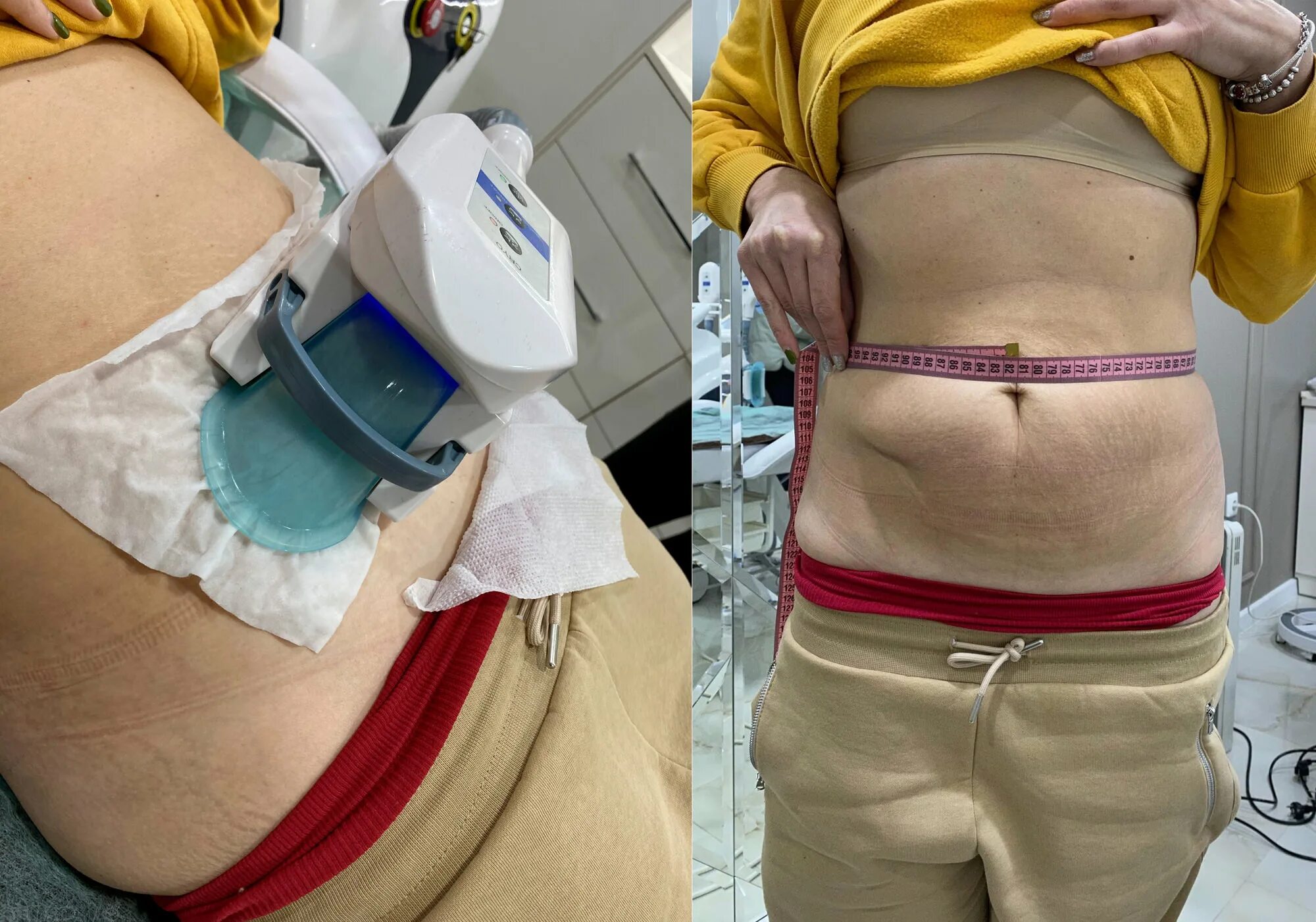 Что делать после криолиполиза. Cryolipolysis аппарат криолиполиз. Криолиполиз 4 манипулы. Криолиполиз Cocoon. Криолиполиз 2 манипулы.