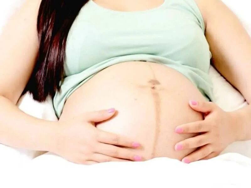 Во время беременности появляется. Полоска на животе при беременности. Полоса на животе у беременных. Пигментная полоса на животе. Полоска на животе у беременной.