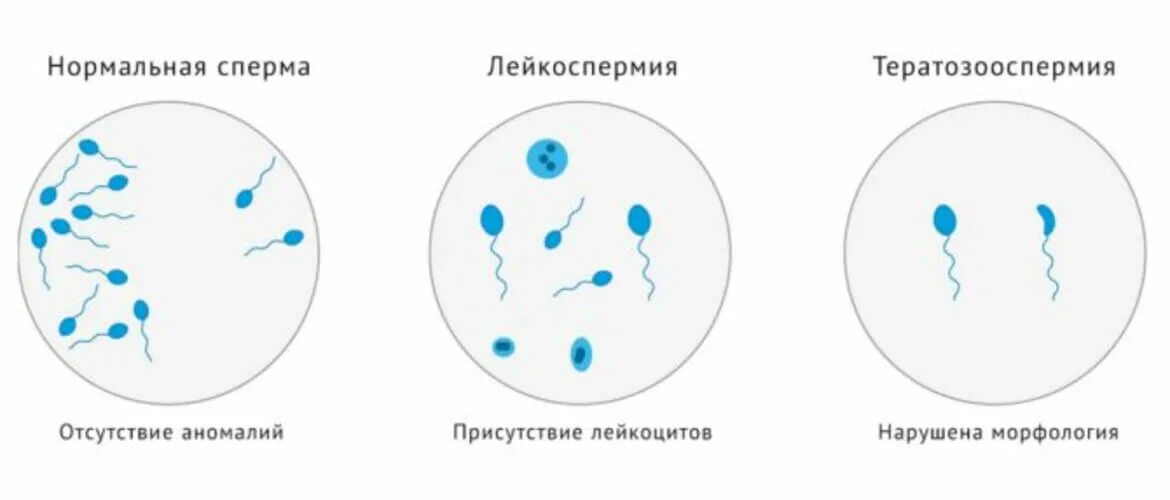 Что будет если кончить в мужчину. Лейкоспермия. Тератозооспермия. Лейкоспермия спермограмма. Мужское бесплодие тератозооспермия.