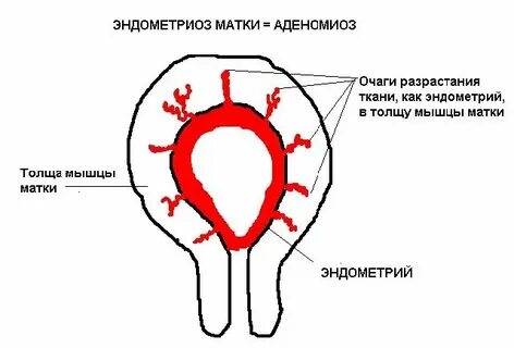 Аденомиоз матки что это простыми