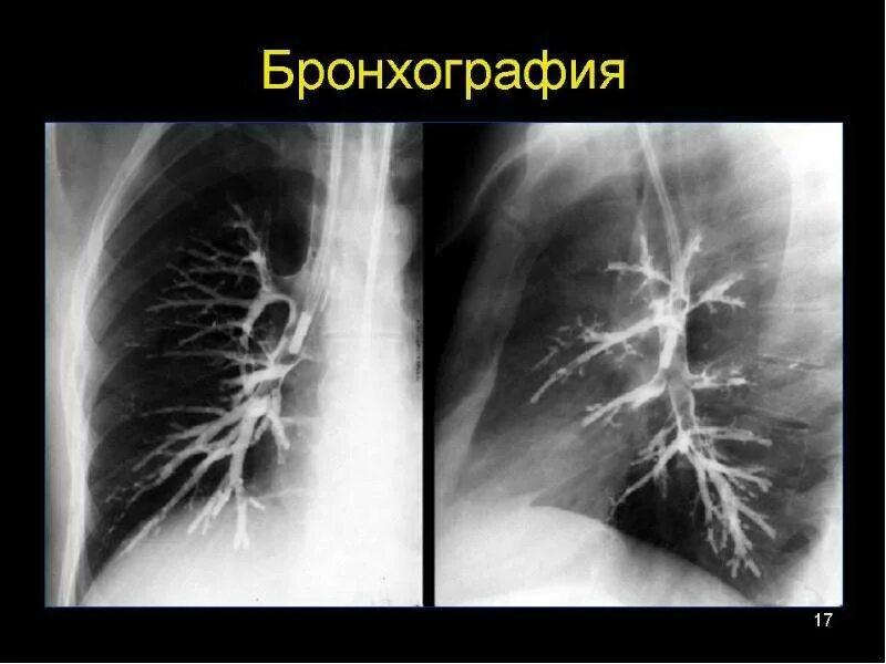 Бронхография бронхоэктазов. Туберкулез бронхов рентген. Воздушная бронхография. Бронхография бронхоэктазы. Бронхография с контрастированием.