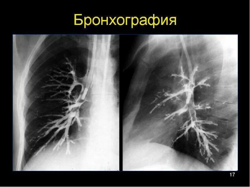 Бронхит бронхоэктатическая болезнь. Бронхоэктазы рентген бронхография. Бронхоэктатическая болезнь бронхография. Бронхография туберкулез бронхов. Бронхоскопия и бронхография.