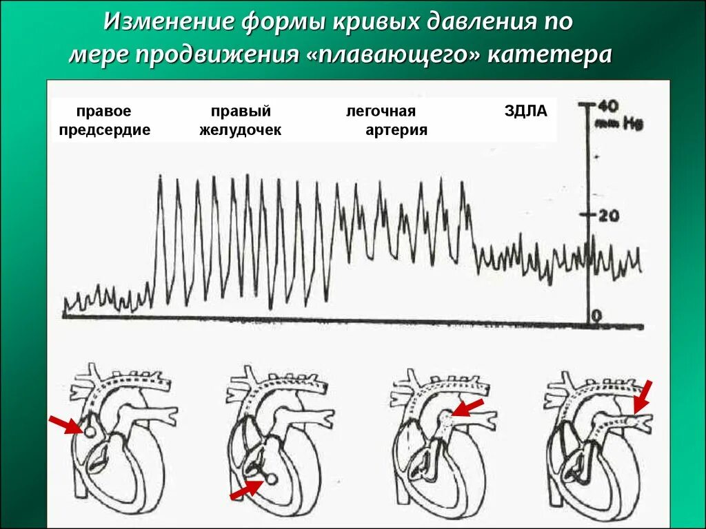 Давление в правом предсердии. Гемодинамические показатели недостаточности кровообращения. Кривая давления предсердия. Кривая давления правого предсердия. Катетеризация правого желудочка.