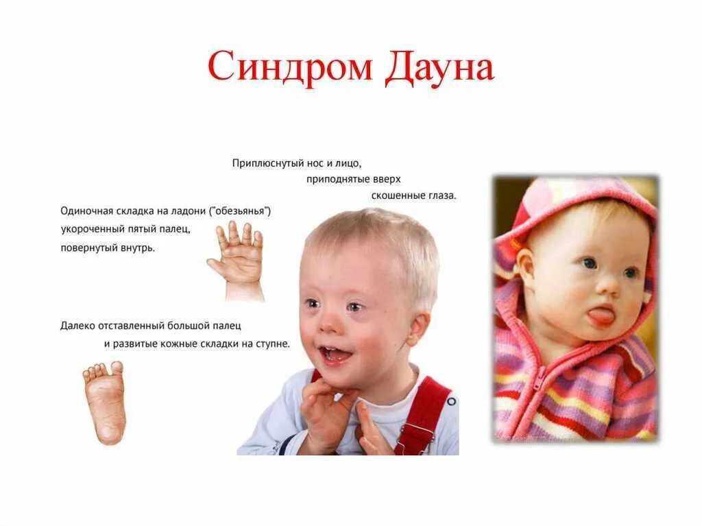 Почему у ребенка синдром дауна. Минимальные диагностические признаки синдрома дауна. синдром дауна симптомы у младенцев. синдром дауна клинические проявления синдрома. болезнь дауна проявления болезни.
