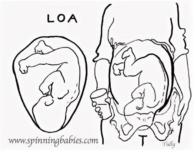 Intrauterine position being left occiput anterior.