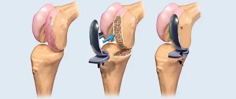 best knee surgeries in kenya