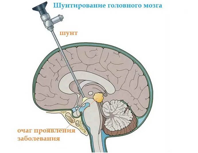 Киста мозга рассосалась. Шунт головного мозга при гидроцефалии. Желудочки головного мозга при гидроцефалии. Арахноидальные кисты головного мозга классификация. Гидроцефалия ликворная киста головного мозга.