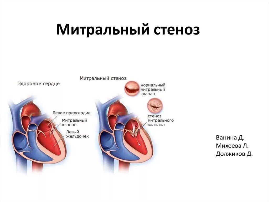 Впс стеноз аортального клапана. Впс стеноз легочной артерии. Порок аортального клапана сердца. Пороки сердца стенозы клапанов недостаточность клапанов. Врожденный стеноз аорты.