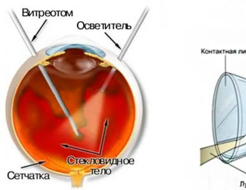 Гемофтальм стекловидного тела. Кровоизлияние в стекловидное тело (гемофтальм). Витрэктомия при гемофтальме. Витрэктомия при отслойке сетчатки. Стекловидное тело операция