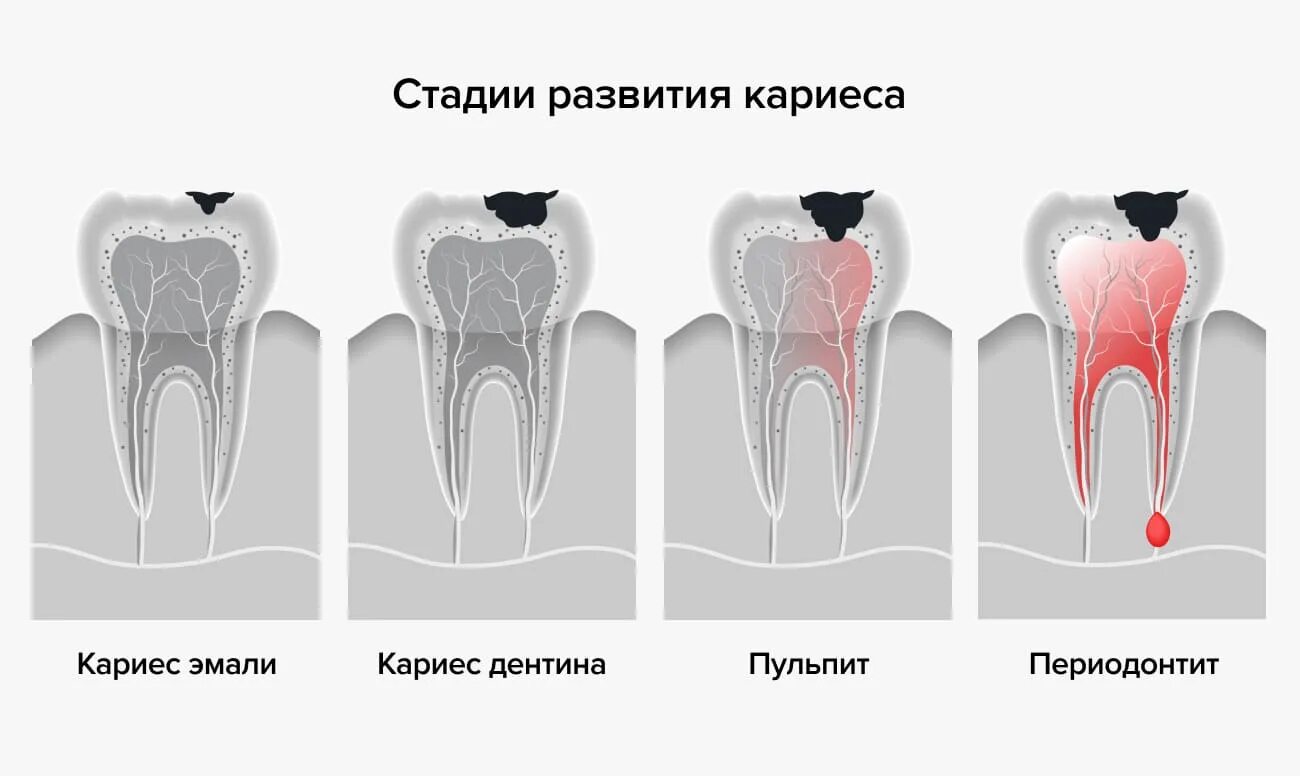 Классификация кариес пульпит периодонтит. Степень разрушения зуба. Стадии развития кариеса. Начальная стадия кариеса. Осложнения лечения кариеса