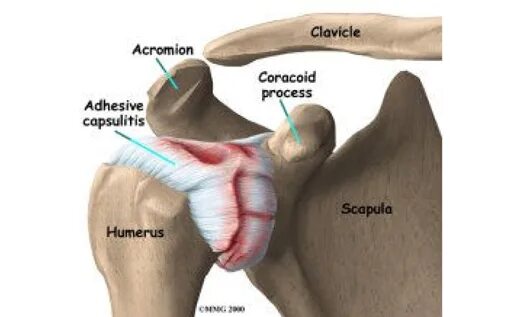 Капсулит плечевого сустава. Адгезивный капсулит плечевого сустава. Суставной капсулит плечевого сустава.