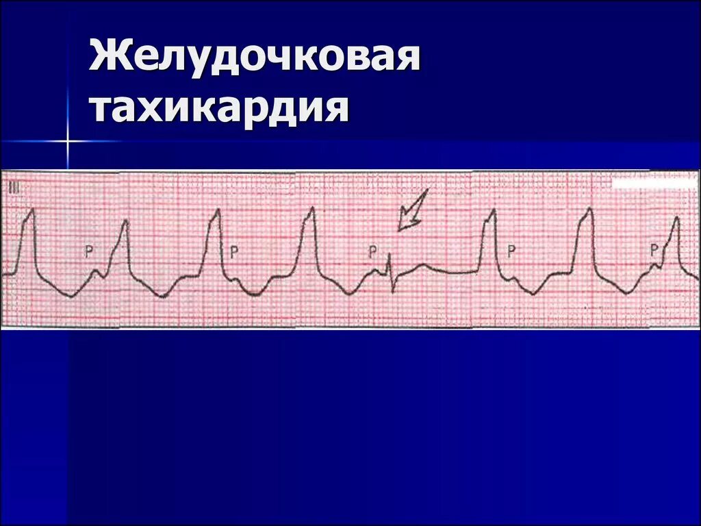 Желудочковая тахикардия на экг. Пароксизмальная желудочковая тахикардия на ЭКГ. ЭКГ при желудочковой тахикардии. Тахикардия желудочков на ЭКГ.