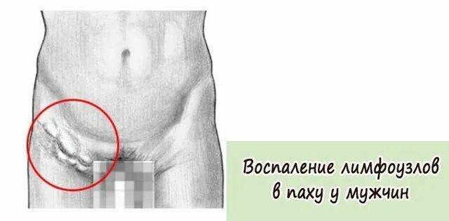 Узлы в паху у женщин расположение ГЛУБОКИЕ ЛИМФОУЗЛЫ ЖИВОТА И ПАХА ЛИМФАТИЧЕСКАЯ СИСТЕМА БОЛЬШОЙ АТЛАС АНАТОМИ