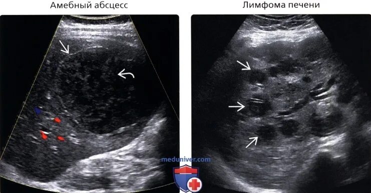 Амебный абсцесс печени. Абсцессы в печени НМ УЗИ. Амебный абсцесс печени на УЗИ. Кистозное образование печени