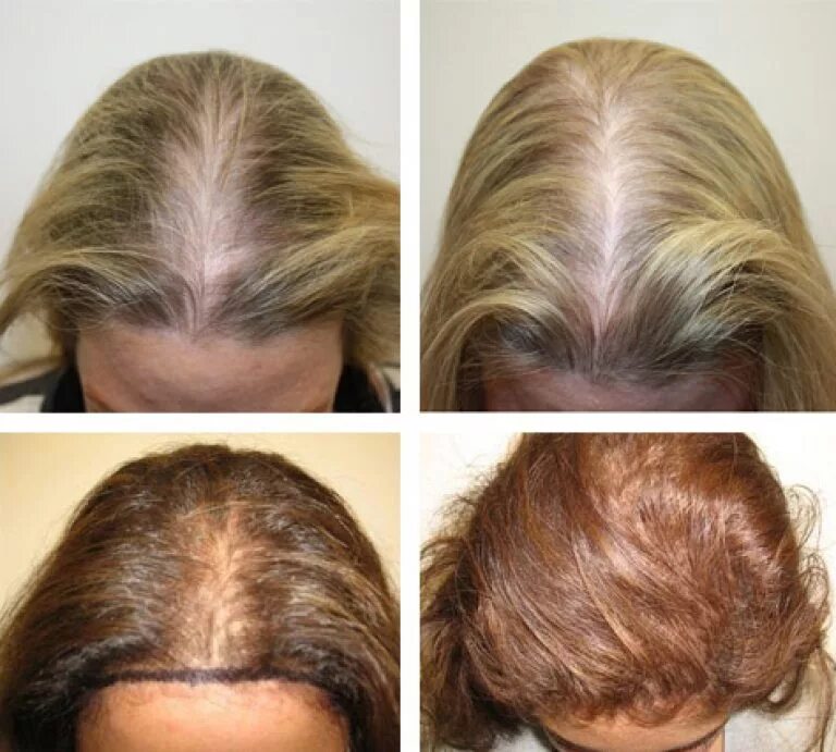 Дарсонваль алопеция андрогенная. Мезотерапия волос до и после. Мезотерапия для кожи головы и волос.