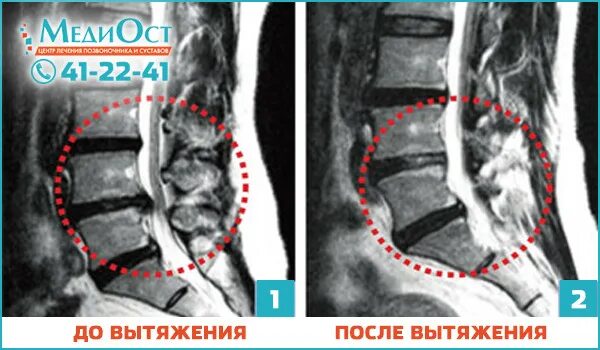 Грыжа диска артроз. Мрт анатомия позвонков спинного. Протрузии позвонков поясничного отдела. Послеоперационные фиброзные изменения дурального мешка. Протрузия дисков поясничного отдела.