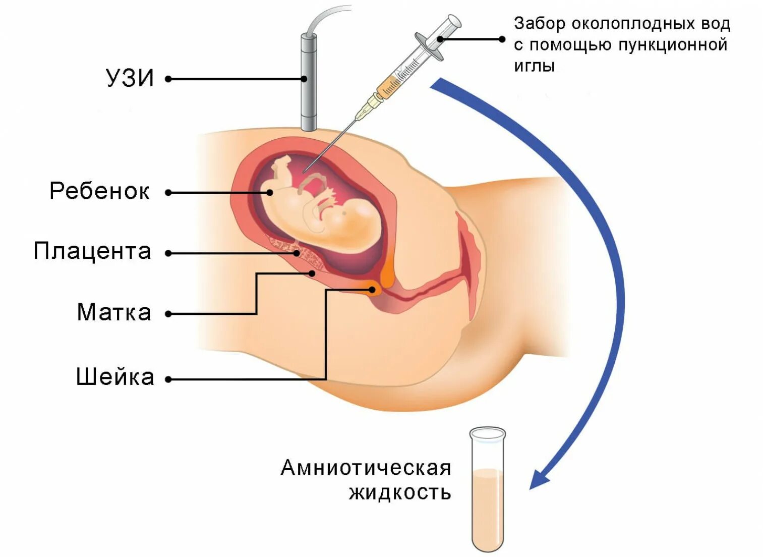 Узи литр воды. Исследование околоплодных вод амниоцентез. Схема проведения амниоцентеза. Пункционный адаптер амниоцентез. Трансабдоминальная биопсия хориона.