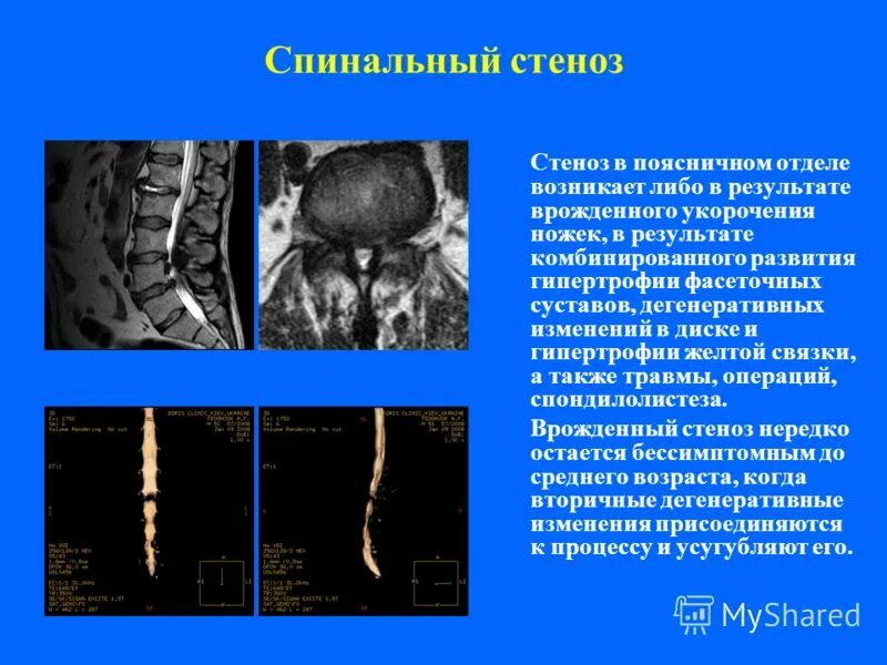 дегенеративный стеноз
