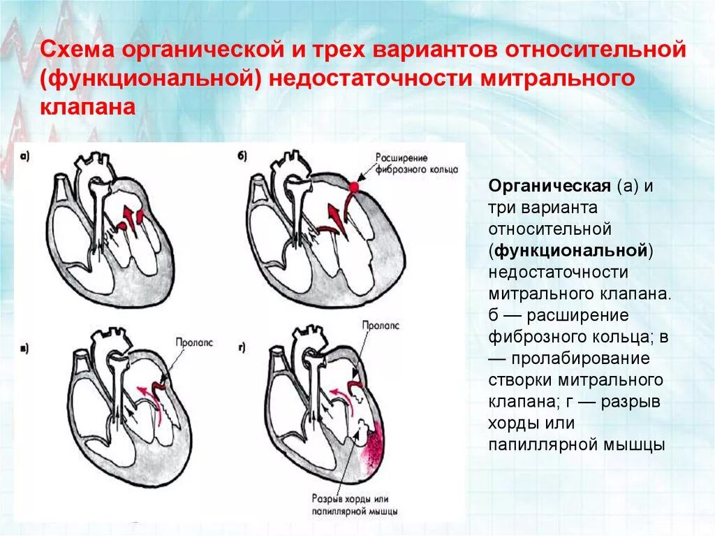 Приобретенный порок сердца митральная недостаточность. Приобретенные пороки сердца схема гемодинамики. Митральная недостаточность схема. Приобретённые пороки сердца недостаточность митрального клапана. Сердечная недостаточность митрального клапана