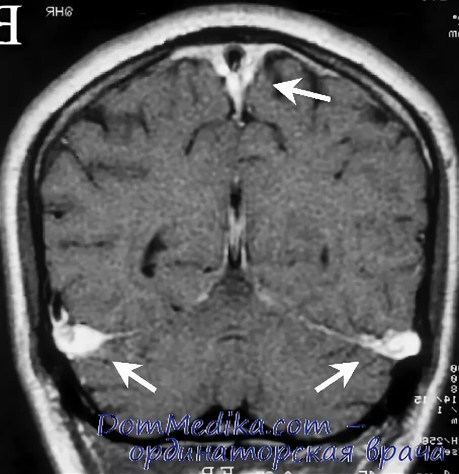 Тромбоз синусов головного мозга кт. Тромбоз венозного синуса головного мозга кт. Тромбоз поперечного синуса головного мозга на кт. Тромбоз сагиттального синуса на кт. Церебрального тромбоза