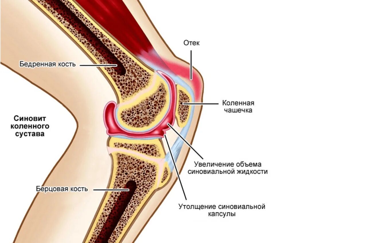 Синовит коленного сустава. Синовит колена коленного сустава. Анатомия коленного сустава синовит. Синовиальная мембрана коленного сустава.