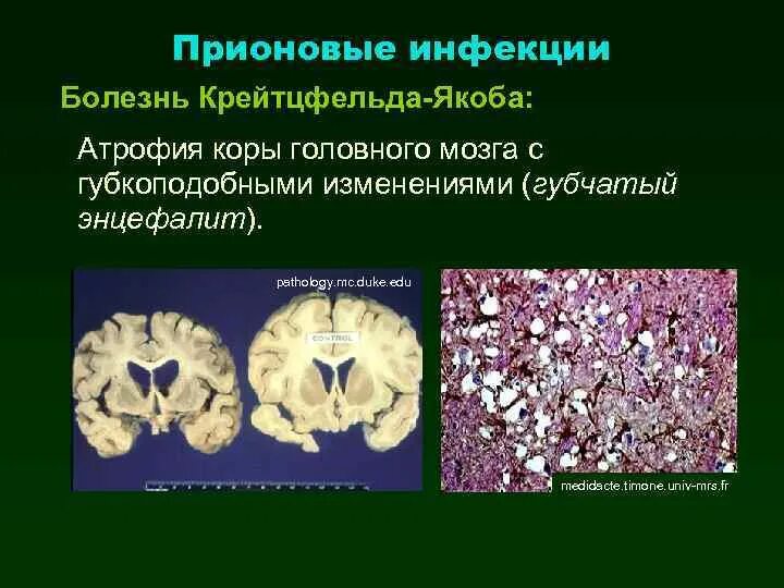 Органические изменения мозга. Прионы болезнь Крейтцфельдта Якоба. Энцефалопатия Крейтцфельдта Якоба. Болезнь Крейтцфельдта-Якоба мозг. Прионы губчатая энцефалопатия.