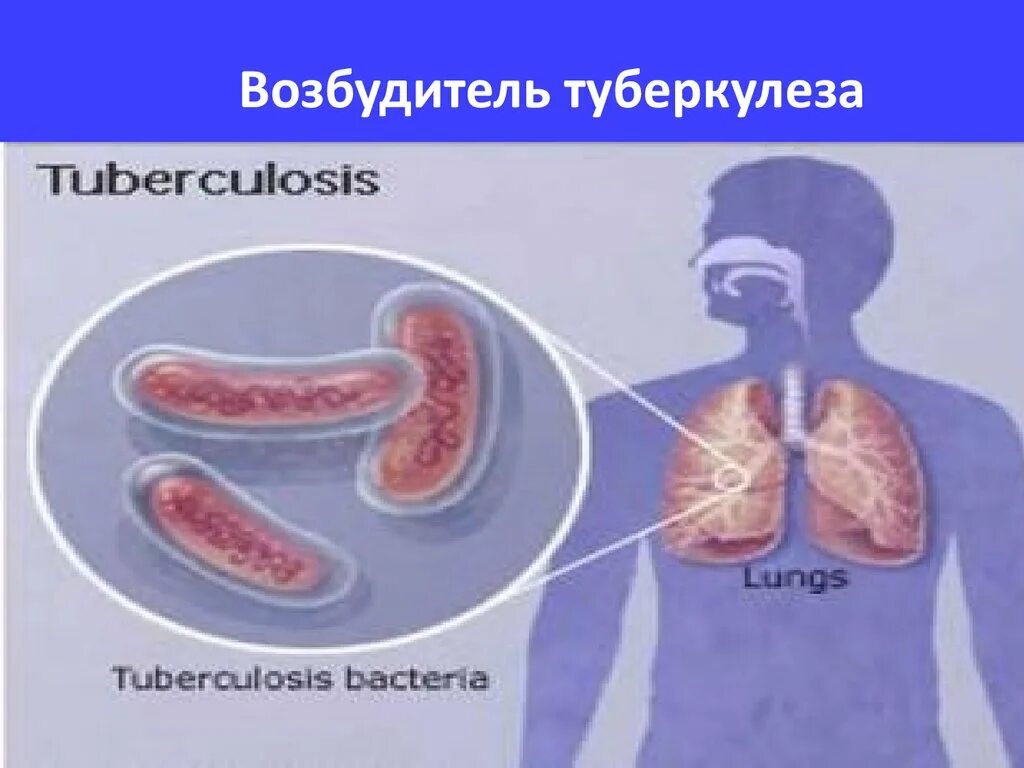 Возбудитель туберкулеза. Возбудители туберкулеза человека. 2. Возбудитель туберкулеза, его формы.